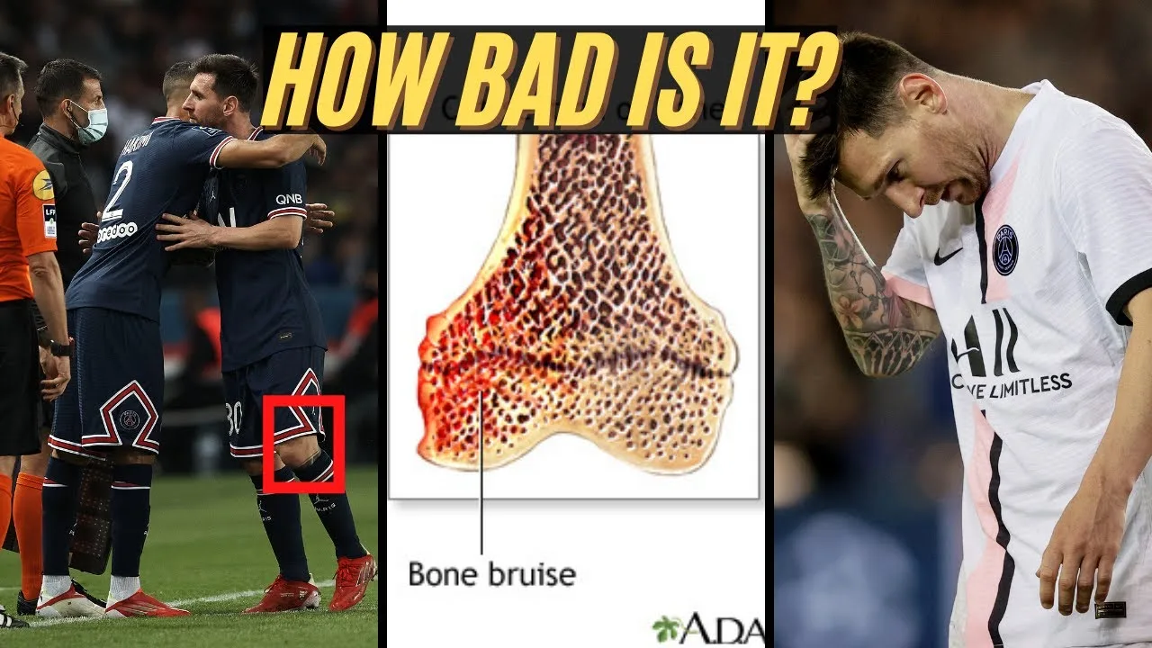 Expert Explains Lionel Messi Injury (knee "bone
